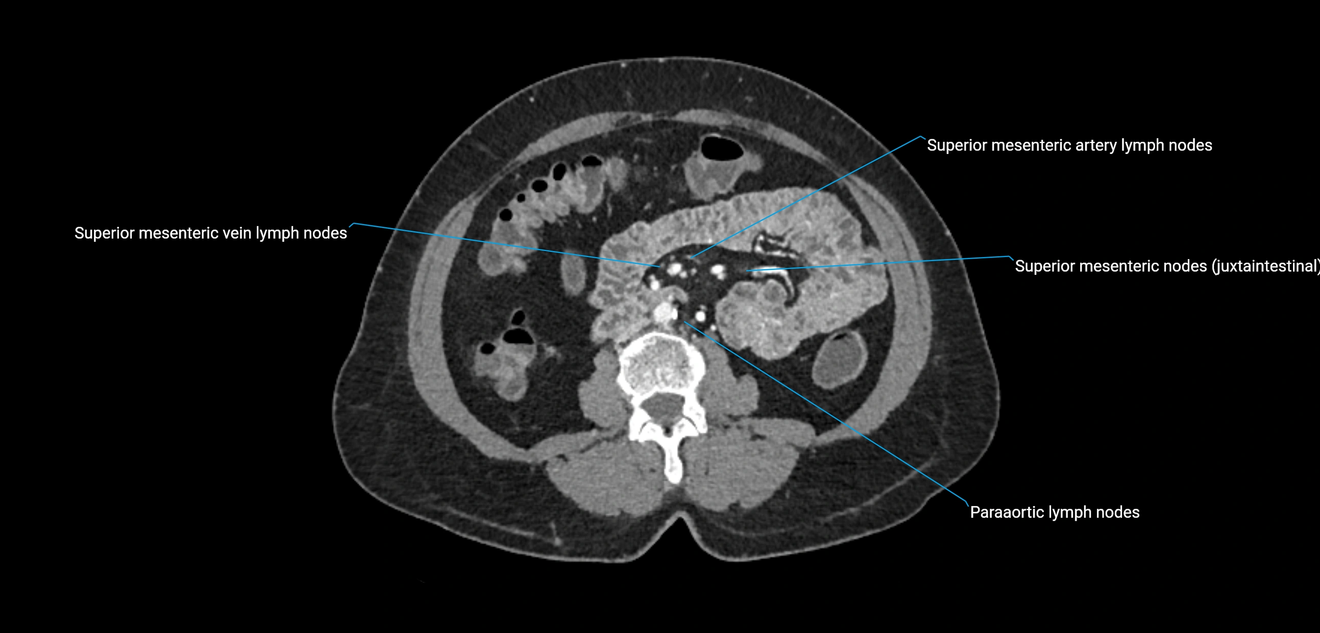 CT ct abdominal lymph nodes  axial cross sectional anatomy  enchanced radiology image -img-00002-00228.webp